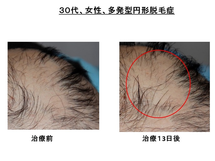 円形脱毛症　病院